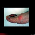 Hallux rigidus