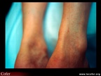 Tendinopathie achilléenne avec épaississement du tendon ; tendinite d'Achille