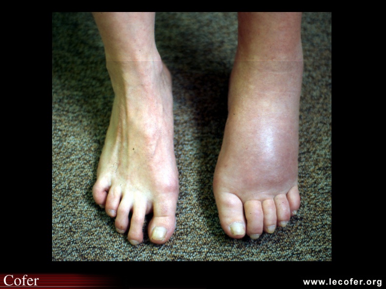 Algodystrophie. 110001044.jpg