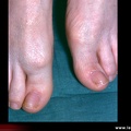 Hallux rigidus vu de face