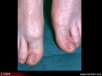 Hallux rigidus vu de face