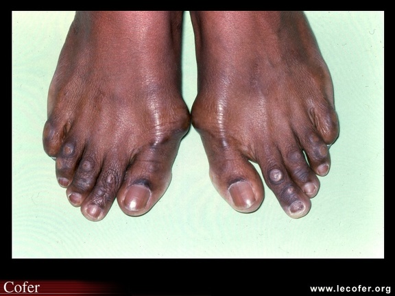 Avant-pied grec avec hallux valgus