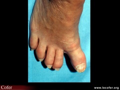 Hallux varus