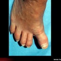 Hallux varus