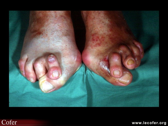 Hallux valgus avec orteils en griffe