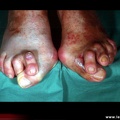 Hallux valgus avec orteils en griffe