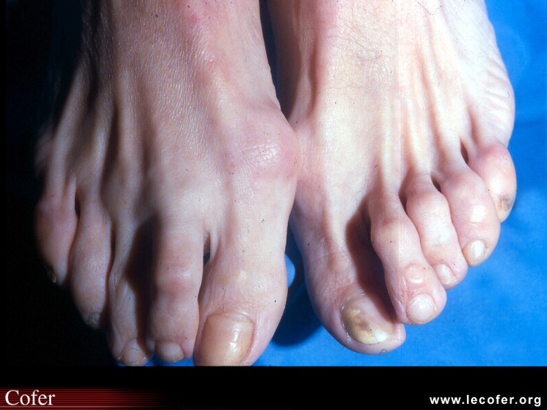 Luxation deuxième articulation métatarso-phalangienne du pied droit. 110001079.jpg