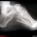 Radiographie pied creux