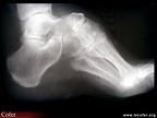 Radiographie pied creux