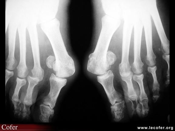 Hallux valgus