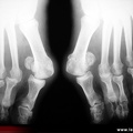 Hallux valgus