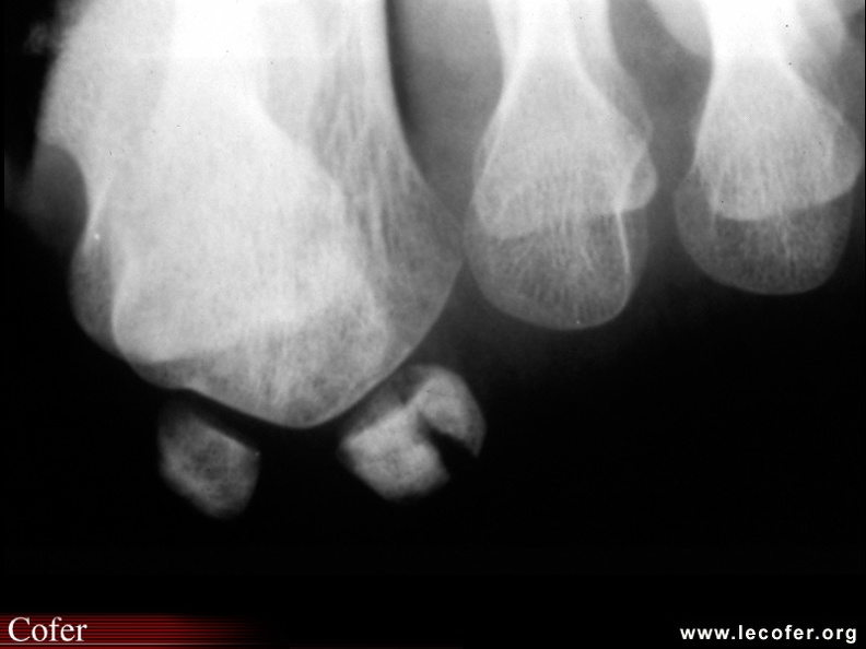 Fracture d’un sésamoïde