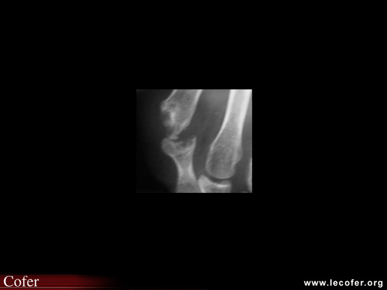 Atteinte de la cinquième tête métatarsienne au cours de la polyarthrite rhumatoïde. 110002010.jpg