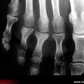 Rhumatisme psoriasique : périostite juxta-articulaire en spicule et en bande