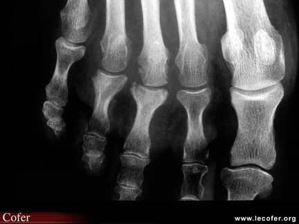 Rhumatisme psoriasique : périostite juxta-articulaire en spicule et en bande