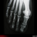 Rhumatisme psoriasique, OP3GO