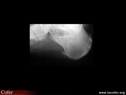 Pelvispondylite rhumatismale, SpA, spondylarthrite ankylosante, spondylarthropathie, calcanéite