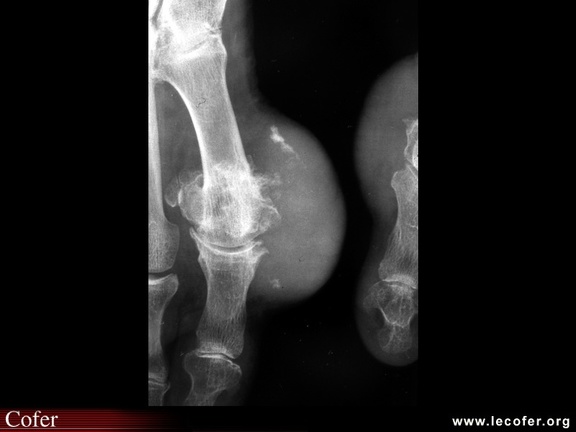 Goutte, pied goutteux avec tophus : aspect radiographique