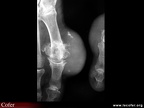 Goutte, pied goutteux avec tophus : aspect radiographique