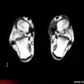 Ténosynovite du tibial postérieur : aspect IRM