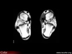 Ténosynovite du tibial postérieur : aspect IRM