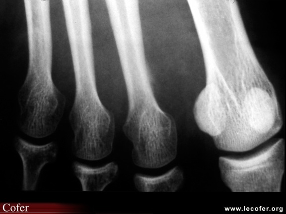 Fracture de fatigue, fissure de fatigue