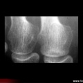 Fracture de fatigue, fissure de fatigue de tête métatarsienne