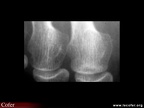 Fracture de fatigue, fissure de fatigue de tête métatarsienne