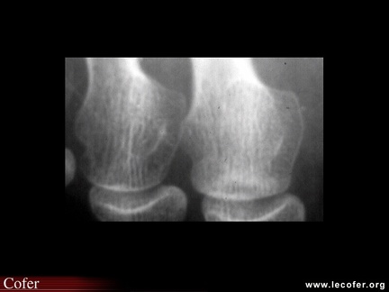 Fracture de fatigue, fissure de fatigue de tête métatarsienne