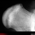 Fracture de fatigue, fissure de fatigue du calcanéum