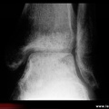 Algodystrophie : aspect radiographique