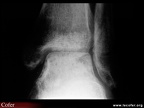 Algodystrophie : aspect radiographique