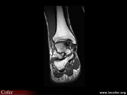Ostéochondrite de cheville