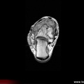 Synovite villo-nodulaire de cheville en IRM