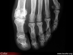 Hallux rigidus : radiographie de face