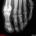 Hallux rigidus : radiographie de face