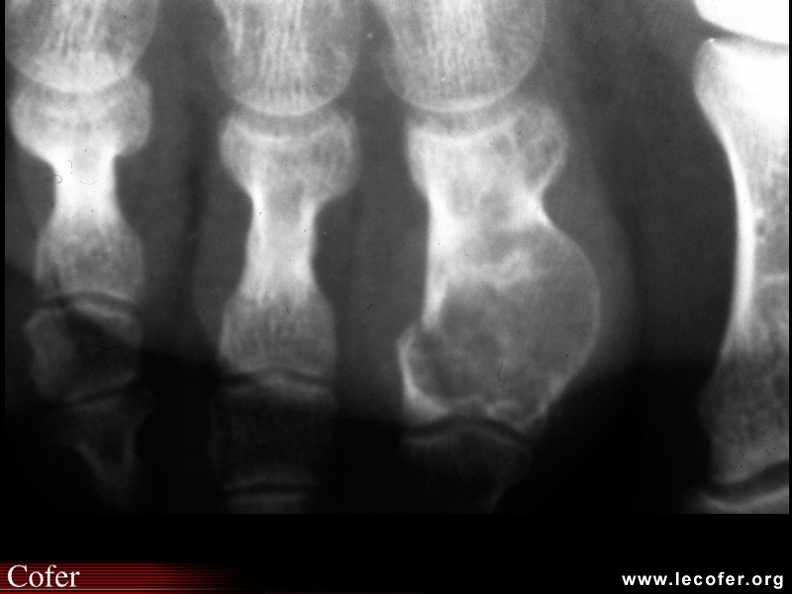 Ostéochondrome de phalange. 110002065.jpg