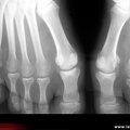 Érosion sésamoïde médial gauche et 5e tête métatarsienne droite au cours d’une polyarthrite rhumatoïde