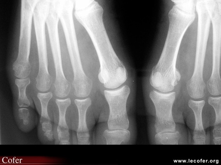 Érosion sésamoïde médial gauche et 5e tête métatarsienne droite au cours d’une polyarthrite rhumatoïde