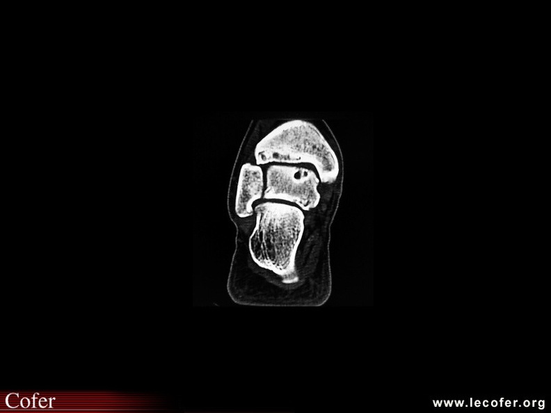 Arthropathie de cheville au cours d’une hémochromatose. 110002072.jpg