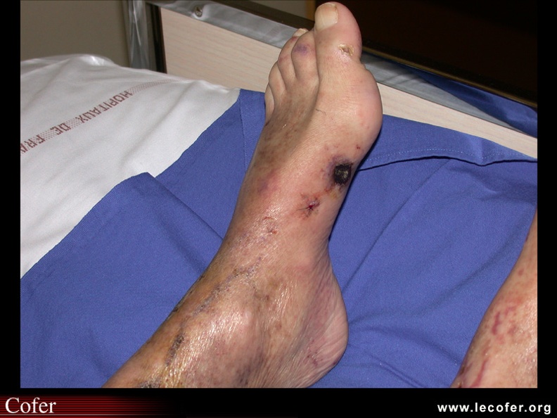 Purpura nécrotique. 20700010.jpg