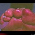 Plages purpuriques livédoïdes des orteils