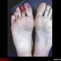 Lésions nécrotiques des orteils
