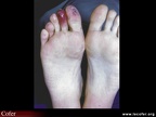 Lésions nécrotiques des orteils