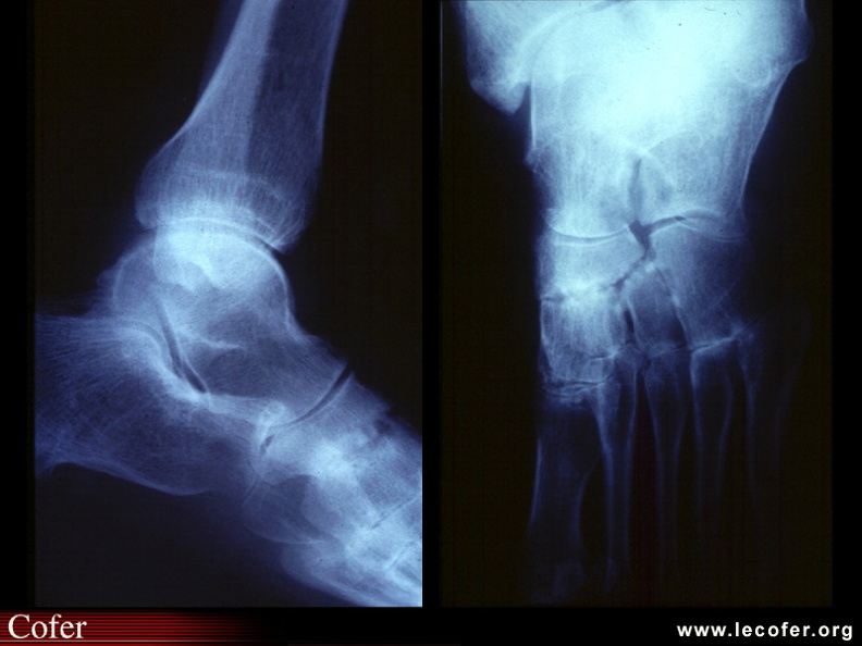Atteinte articulaire destructrice du médio-pied et de la cheville. Ni le pincement articulaire, ni les érosions n'ont d'aspect spécifique de la MSA. SA006.jpg