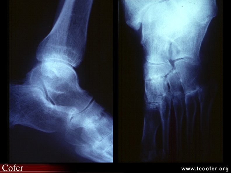 Maladie de Still de l'adulte / maladie de Still : tarsite érosive